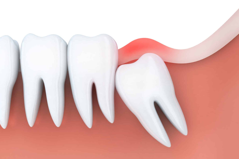 Wisdom Teeth Removal Recovery Tips for a Smooth Healing Process