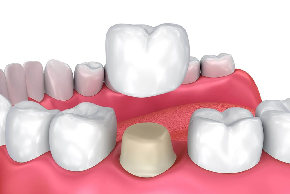 Looking for dental crown Airdrie services? Discover how dental crowns restore damaged teeth, improve your smile, and protect your oral health. Learn why choosing a dental crown near you can make treatment faster and more comfortable.